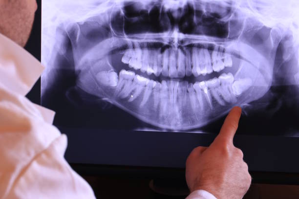 Best Emergency Wisdom Tooth Extraction in Glespie, IL